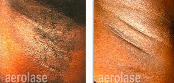 DiscovHER Health Aerolase Hair Removal Results