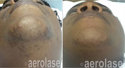 DiscovHER Health Aerolase Hair Removal Results