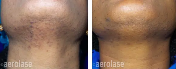 DiscovHER Health Aerolase Hair Removal Results