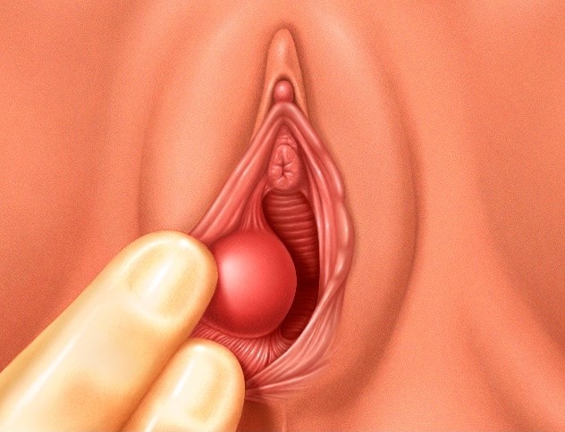 Bartholin Cyst | DiscovHER Health | Complex GYN and Sexual Health Specialist serving Washington D.C., Maryland, and Virginia. Virtual and In-person appointments available!