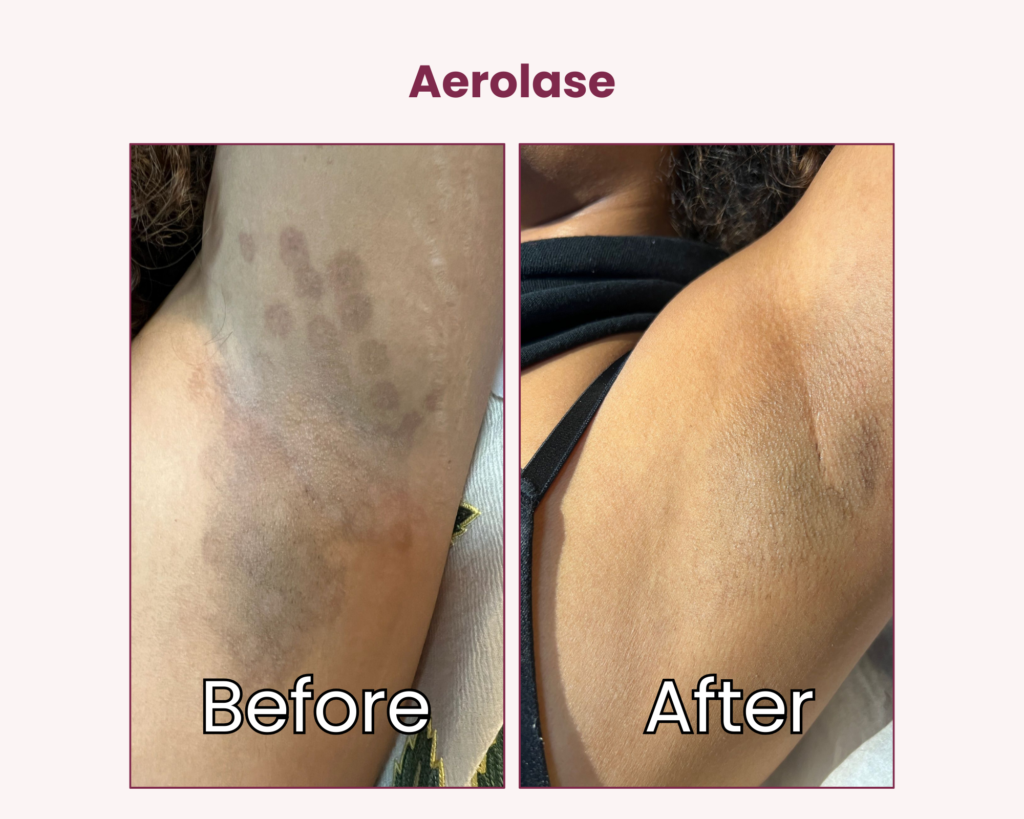 Aerolase Laser Before and After